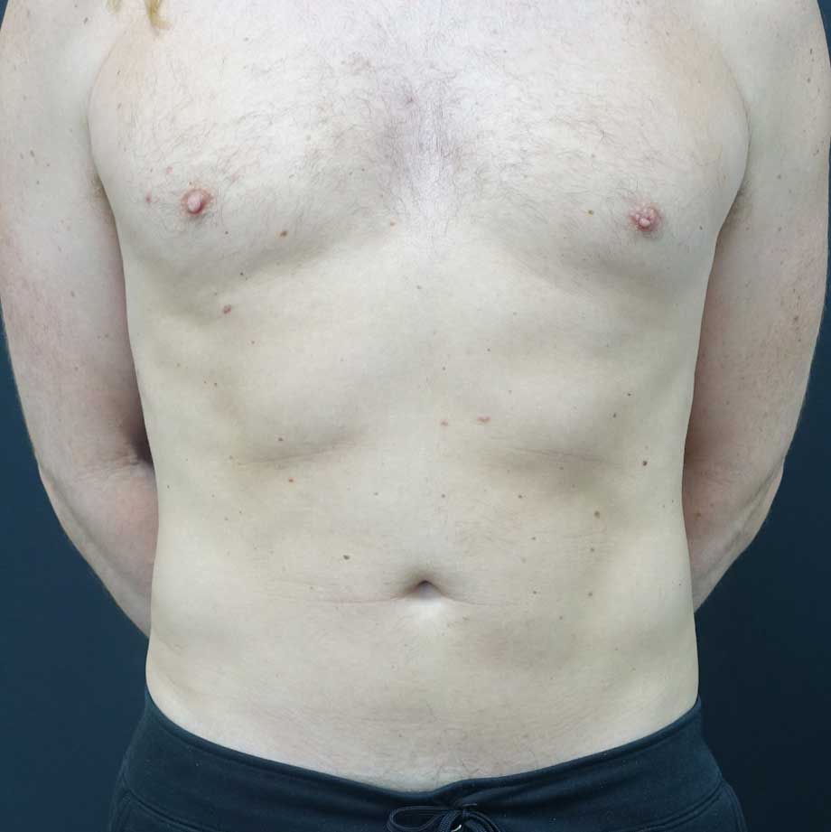 Vaser Liposuction