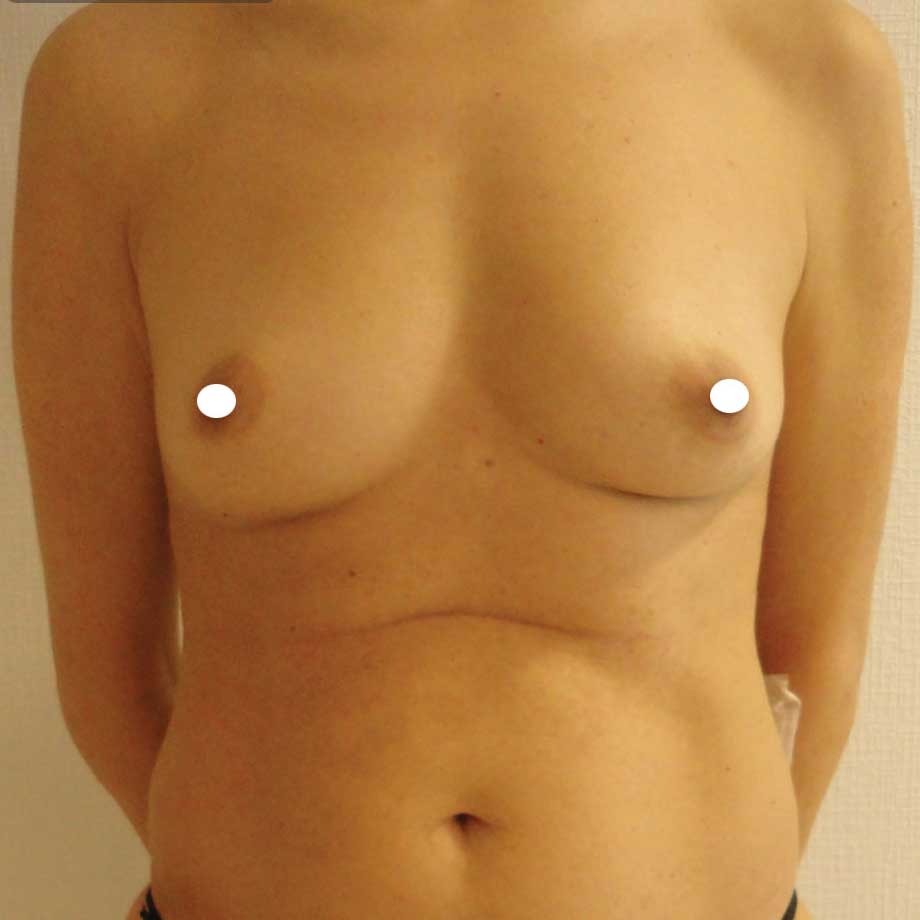 Breast Augmentation